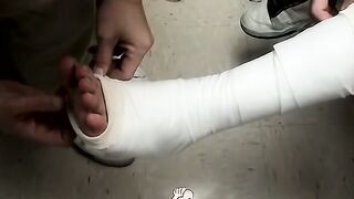 Foot cast placed on twink and his leg before being taken off