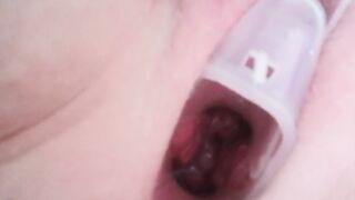 Cervix play