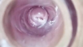 Clear tunnel plug with cervix see