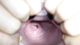 Cervix close up