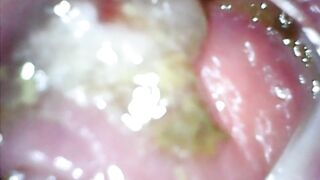 Anal endoscope part two