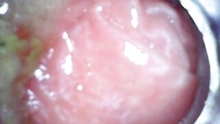 Anal endoscope part two