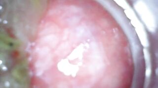 Anal endoscope part two