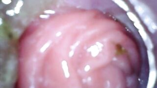 Anal endoscope part two