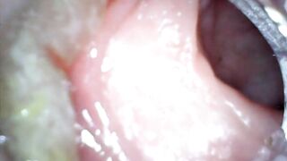 Anal endoscope part two