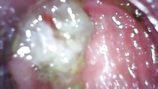 Anal endoscope part two