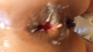 Extreme Anal Fisting Amateurs